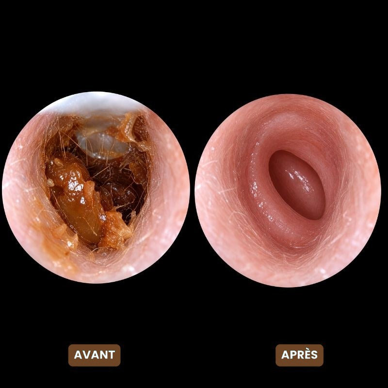 Conduit auditif avant et après Auricléa™